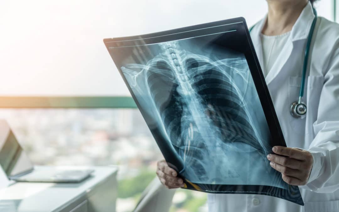 Is Asbestos the Only Cause of Mesothelioma?