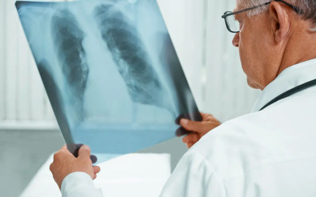 How Mesothelioma Affects the Body